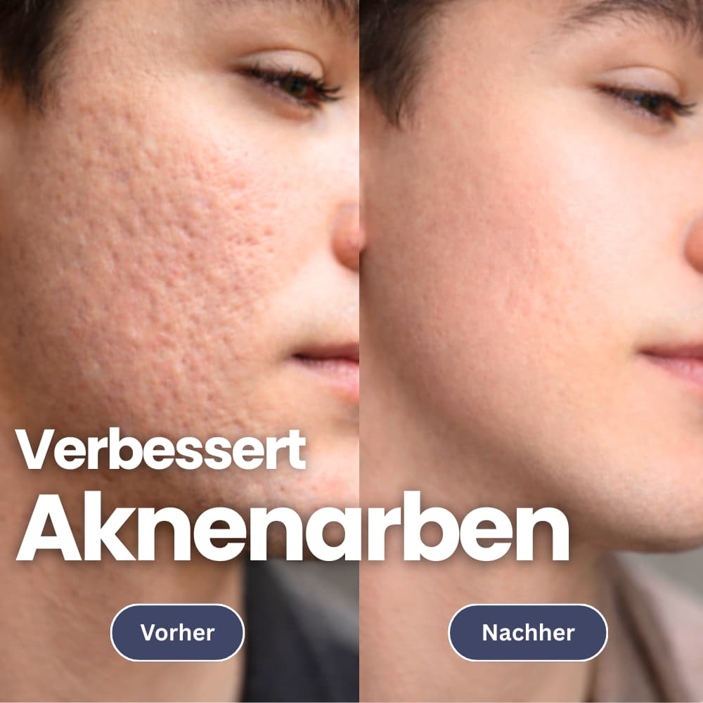 Microneedling Infusionset für eine straffe Haut