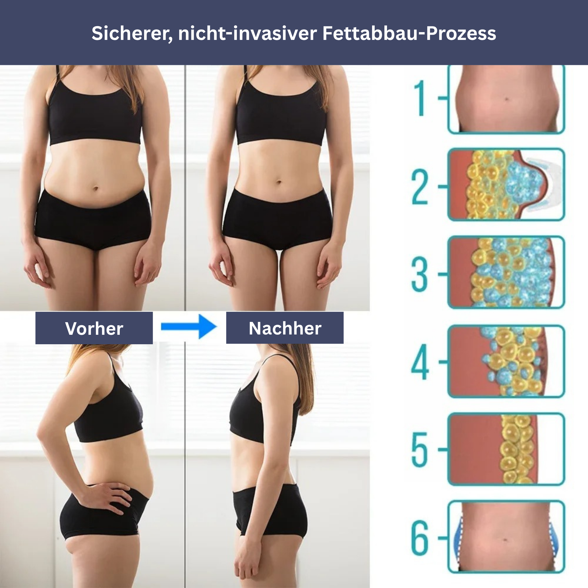 IceContour - Massagegerät für Bauch & Cellulite